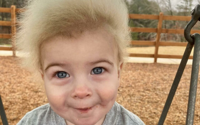 The Toddler With Extremely Rare Uncombable Hair Syndrome